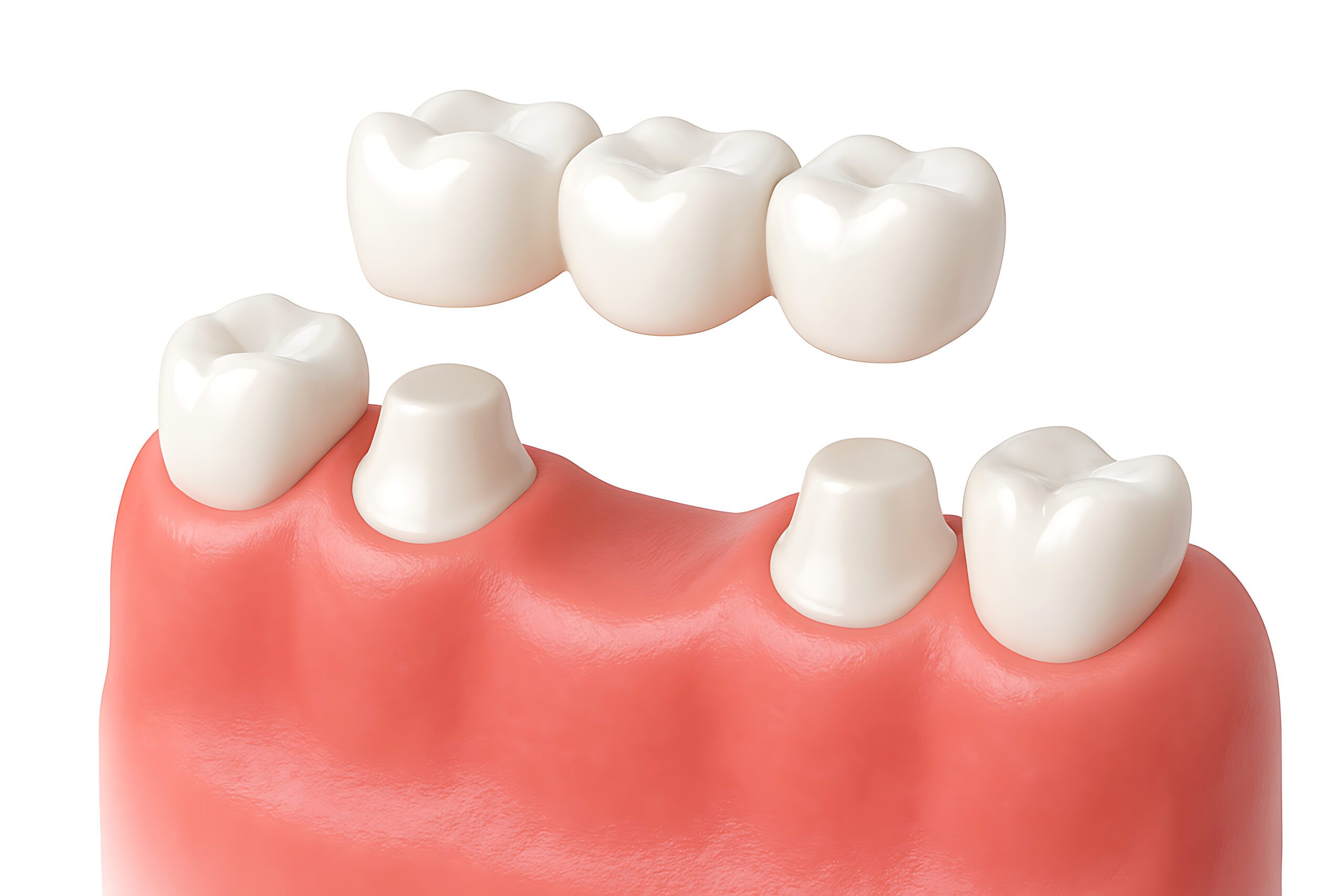Dental bridge model showing prepared abutment teeth and prosthetic crowns