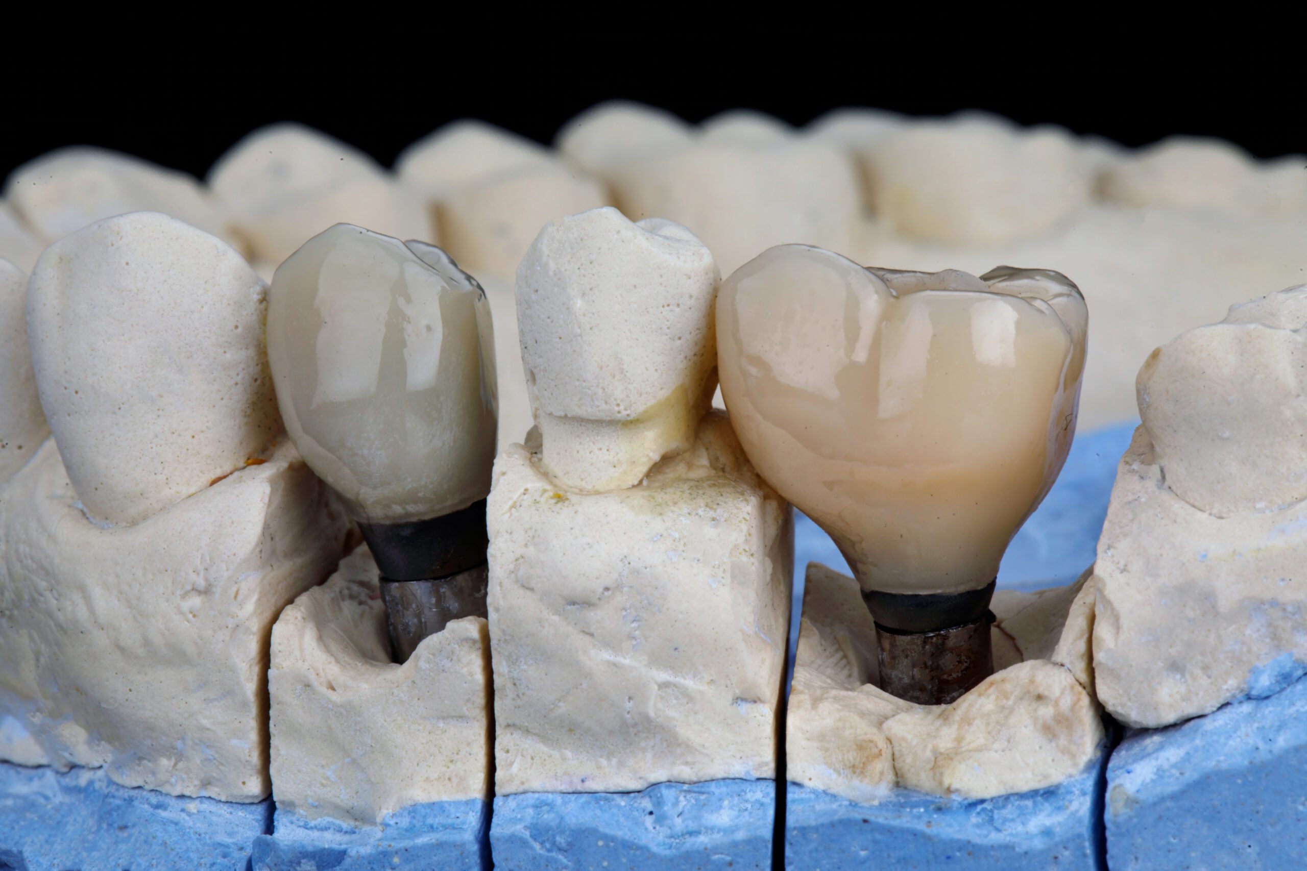 dental crown in the chewing area on a plaster cast