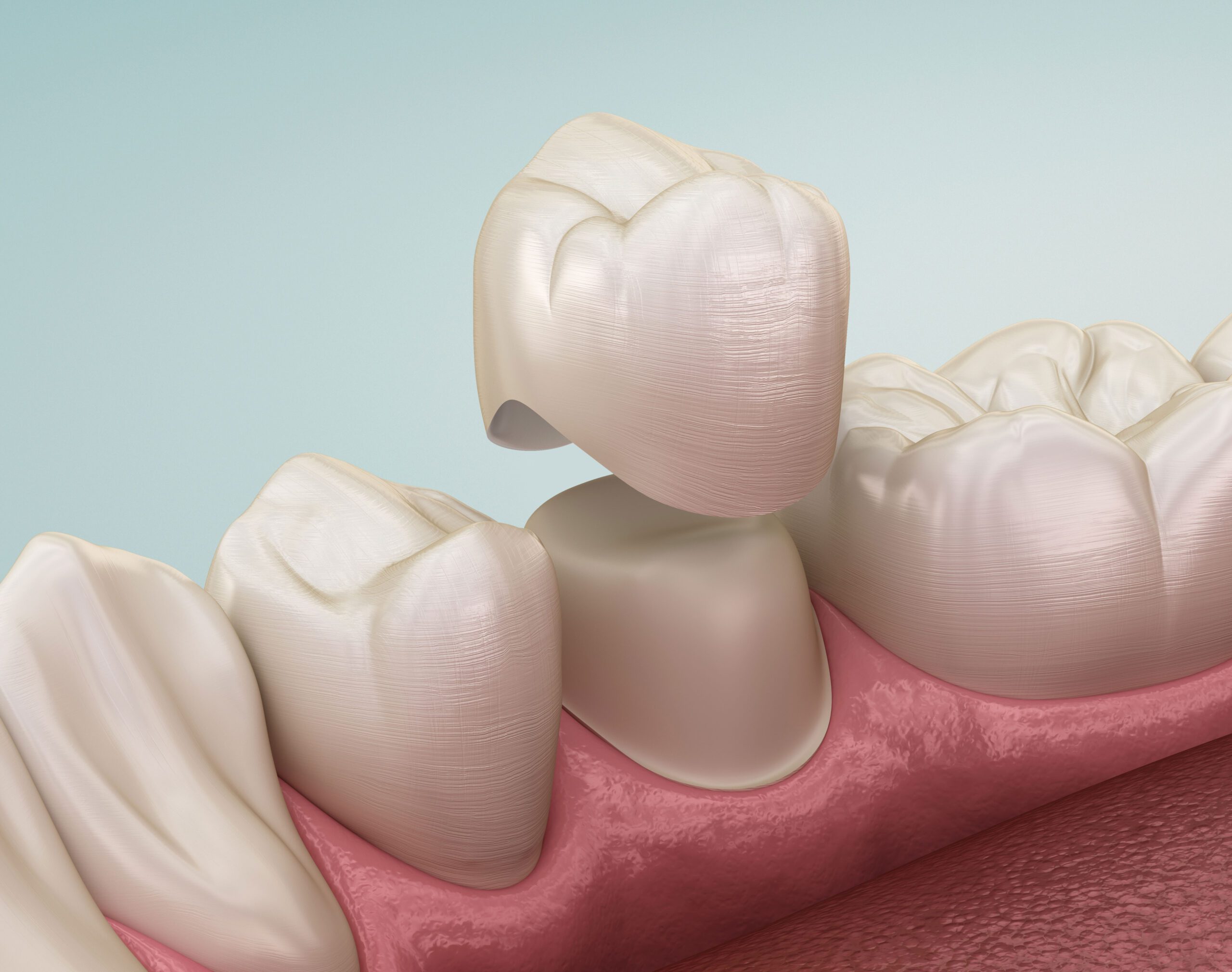 dental-crown-premolar-tooth-assembly-process-medically-accurate-3d-illustration-human-teeth-treatment