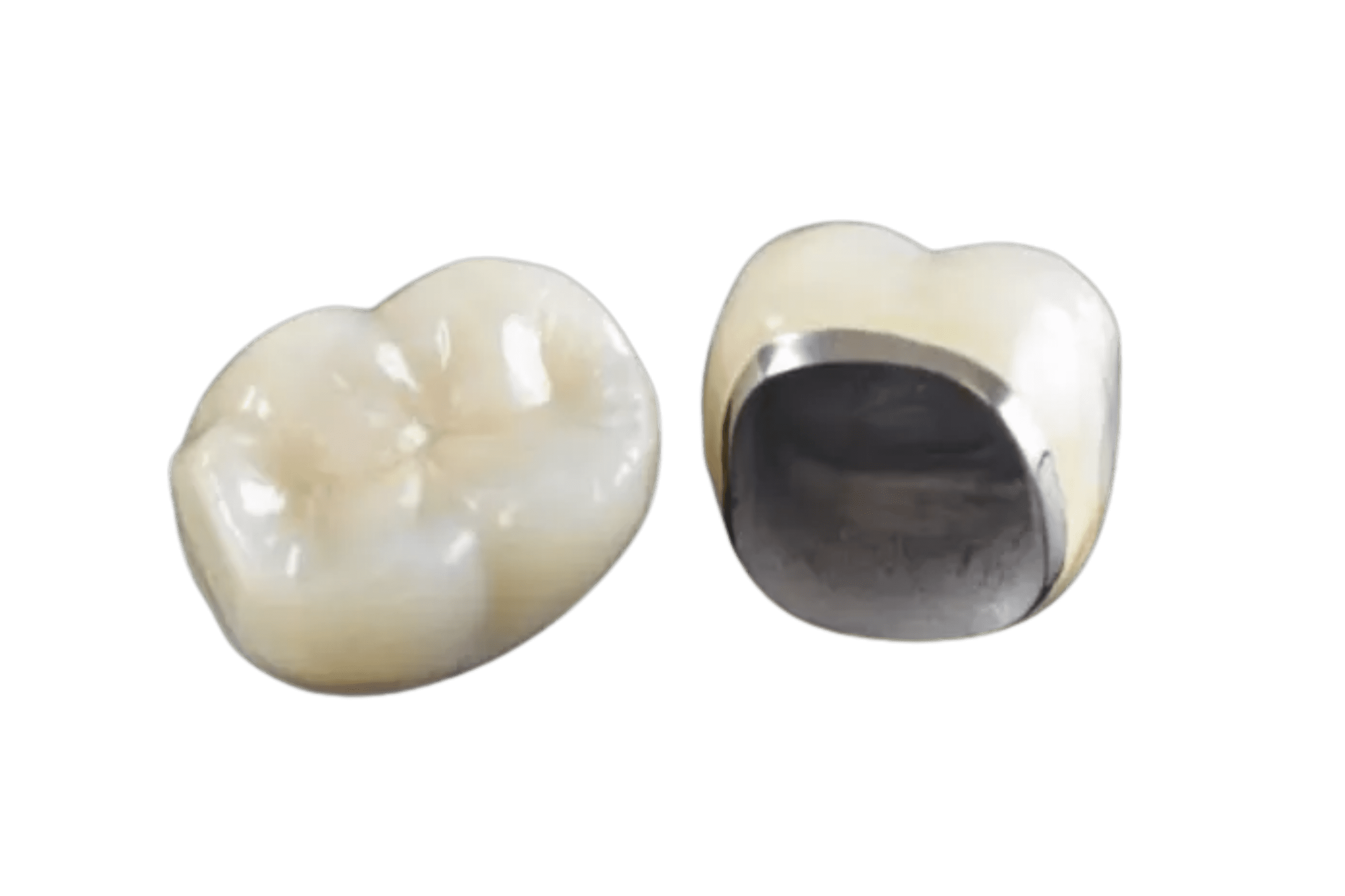 porcelain fused to metal crown