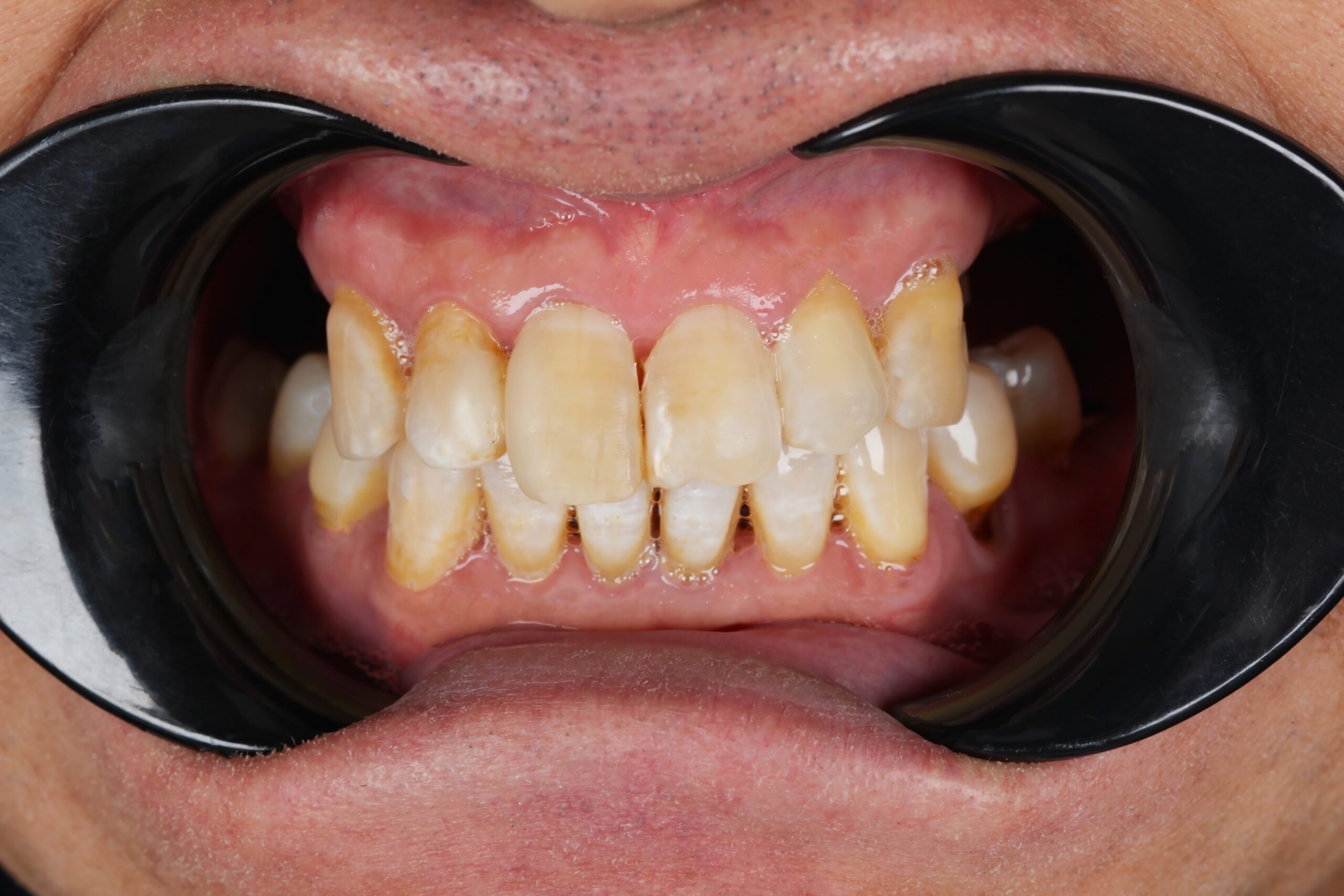 Smiling mouth of a man with crooked ugly yellow teeth close-up. High quality photo