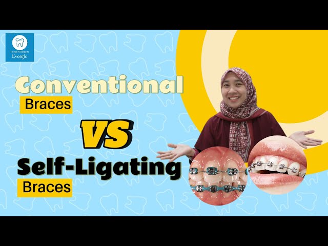 Conventional Braces VS Self-Ligating Braces